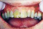 Before CEREC