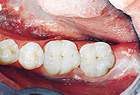 After CEREC