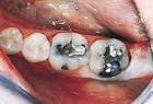 Before CEREC