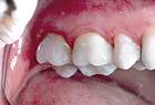 cerec