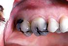 Before CEREC