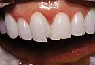 Before CEREC