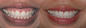 Before and After Pictures. Gummy Smile. Dorothy Gogol-Mach DDS